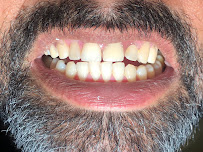 Dr. Paulo Camurça. Tratamento de Canal , Implante e Prótese. Dentista Fortaleza José Walter