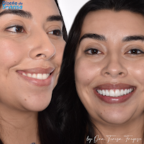 Diseño de Sonrisa
