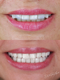 Dra. Ana Flávia Azevedo | Facetas em Resina | Belo Horizonte
