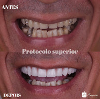 Implante Dentário | Lente de Contato Dental | Amorim Odontologia | São Geraldo | Manaus - AM