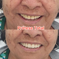 Dentista Manaus - Dra Irla Thaís - Prótese Dentária