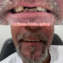 Dentista Manaus - Dra Irla Thaís - Prótese Dentária