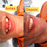 Dentista Manaus - Dra Irla Thaís - Prótese Dentária