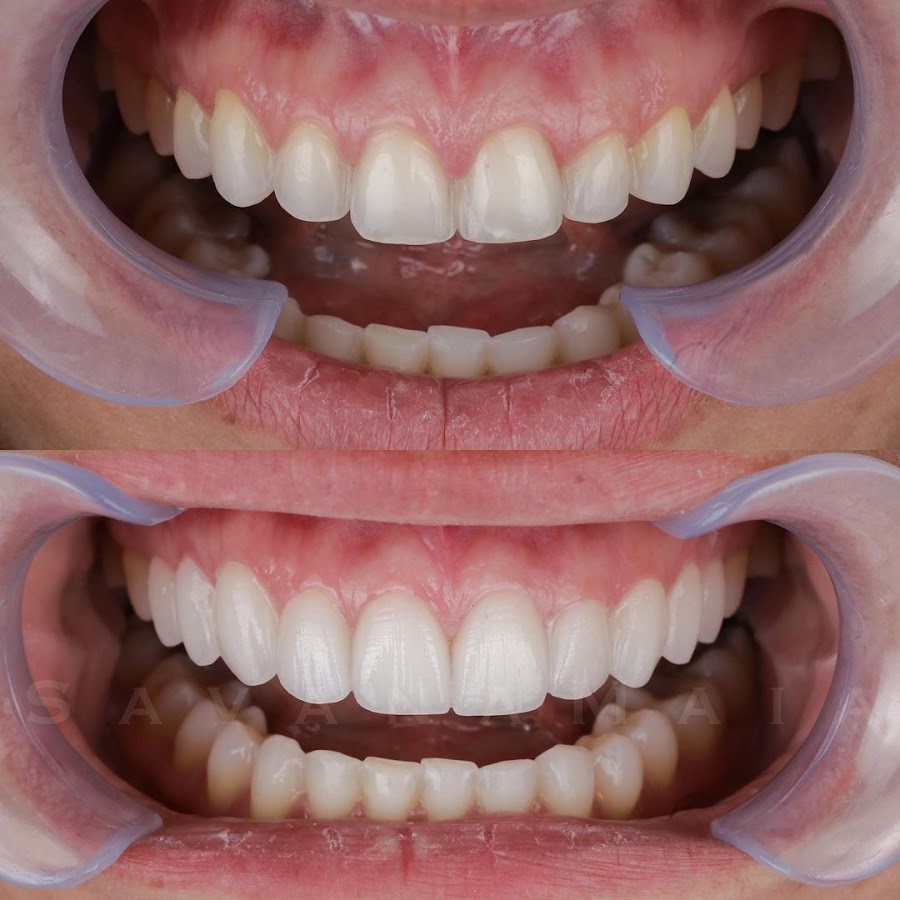 Odontologia Savana Maia - Lente de Contato Dental - Invisalign - implante dentário - dental clinic in Manaus, Brazil