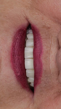 Odontologia Savana Maia - Lente de Contato Dental - Invisalign - implante dentário