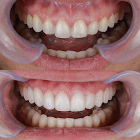 Odontologia Savana Maia - Lente de Contato Dental - Invisalign - implante dentário in Manaus