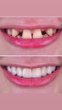Odontologia Savana Maia - Lente de Contato Dental - Invisalign - implante dentário