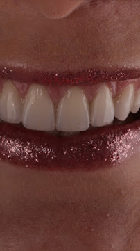 Odontologia Savana Maia - Lente de Contato Dental - Invisalign - implante dentário