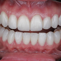 Odontologia Savana Maia - Lente de Contato Dental - Invisalign - implante dentário