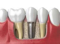 Cliniimplant Reabilitação odontológica Integrada