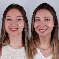 Blanvur | Facetas de Resina Híbridas em Curitiba