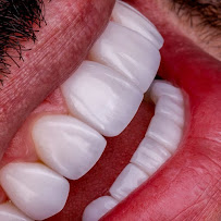 Blanvur | Facetas de Resina Híbridas em Curitiba