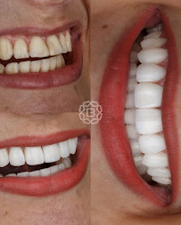 Blanvur | Facetas de Resina Híbridas em Curitiba