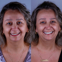 Blanvur | Facetas de Resina Híbridas em Curitiba