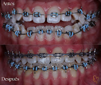 Diseño de Sonrisa en Guadalajara Dra Luly Mata Dentista