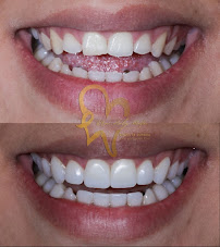 Diseño de Sonrisa en Guadalajara Dra Luly Mata Dentista