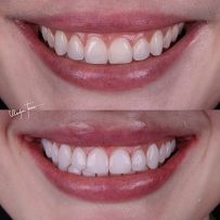 Dra. Vladja Torno | Facetas em Resina Composta em Curitiba