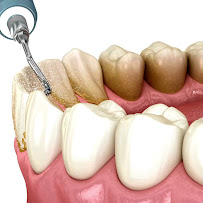 Dr. Rafael Pocztaruk - Implante Dentário Porto Alegre l Lentes em Resina Premium l Faceta Porcelana l Protocolo de Implante