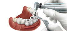 Toresan Odontologia: implante dentário, ortodontia, clareamento dental, lente de contato dental, periodontia, endodontia