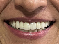 Dra. Clarissa Freitas - Faceta de Porcelana em Campinas