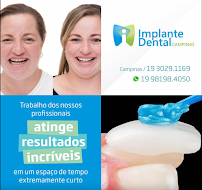 Implante Dental Campinas