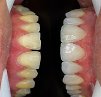 Implante Dental Campinas