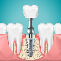 Implante Dental Campinas