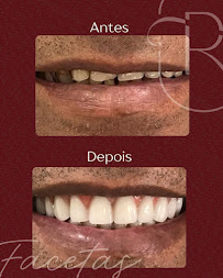 Rudini Odontologia | Implante Dentário | Dentista | Vila Nogueira | Campinas - SP