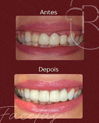 Rudini Odontologia | Implante Dentário | Dentista | Vila Nogueira | Campinas - SP