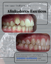 Dra. Rosangela Santos | Dentista em Maceió | Facetas em Resina em Maceió