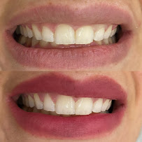 Dra. Rosangela Santos | Dentista em Maceió | Facetas em Resina em Maceió
