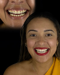 Dra. Rosangela Santos | Dentista em Maceió | Facetas em Resina em Maceió