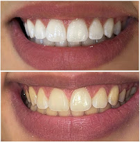 Dra. Rosangela Santos | Dentista em Maceió | Facetas em Resina em Maceió