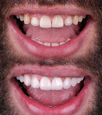Dra. Rosangela Santos | Dentista em Maceió | Facetas em Resina em Maceió