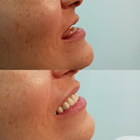 Dra. Rosangela Santos | Dentista em Maceió | Facetas em Resina em Maceió
