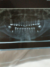 Oral Sin Implantes Maceió
