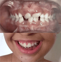 Clínica Odontológica Dr. Marcus Brêda em Jatiúca Maceió, Plano De Saúde, Extração do Siso, Implante Dentário, Cirurgia