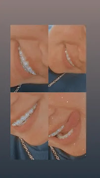 Odontologia Integrada Natal | Implante sem corte, sem dor e resultado imediato | Dentista em Natal/RN