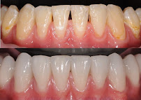 Odontologia Integrada Natal | Implante sem corte, sem dor e resultado imediato | Dentista em Natal/RN