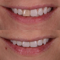 Odontologia Integrada Natal | Implante sem corte, sem dor e resultado imediato | Dentista em Natal/RN