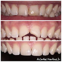 IOP - Ortoestética Lagoa Nova: Implante dentário, Clareamento Dental, Dentista, Natal RN