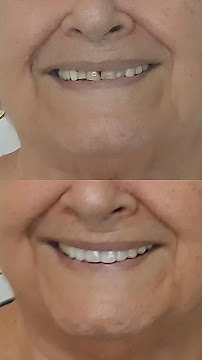 Dr. Jefferson Lopes | Dentista em Natal - prótese, implante dentário, clareamento dental, facetas. Clínica odontológica.