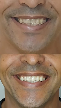Dr. Jefferson Lopes | Dentista em Natal - prótese, implante dentário, clareamento dental, facetas. Clínica odontológica.