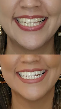 Dr. Jefferson Lopes | Dentista em Natal - prótese, implante dentário, clareamento dental, facetas. Clínica odontológica.