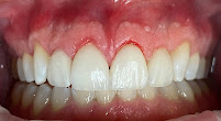 Fonsêca Odontologia | Implantes