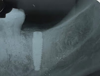 Fonsêca Odontologia | Implantes