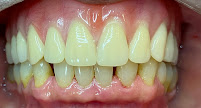 Fonsêca Odontologia | Implantes