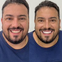 Líder Odontologia - Campo Grande, Implantes dentários, Próteses, Alinhadores