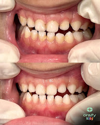 Oralfy Teresina - Implantes • Facetas • Invisalign • Próteses