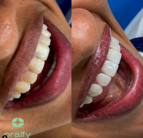 Oralfy Teresina - Implantes • Facetas • Invisalign • Próteses